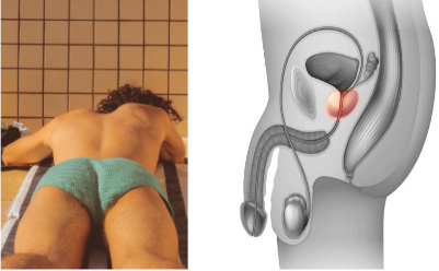 prostate final